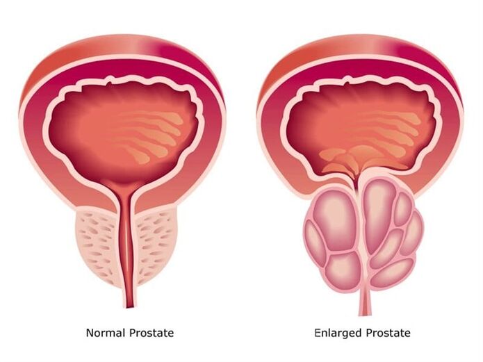 Prostovit normalizează activitatea și dimensiunea prostatei