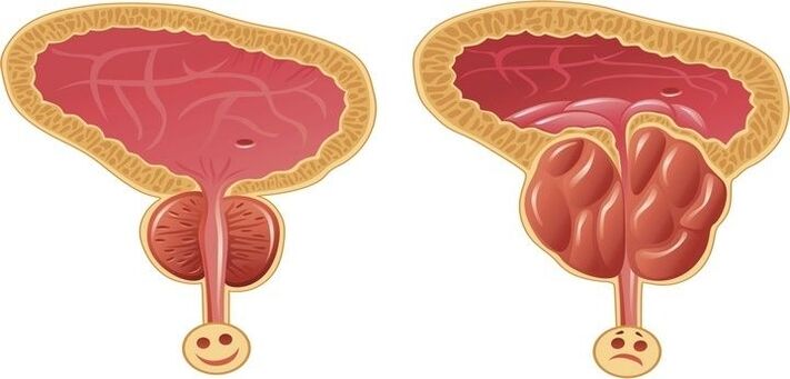 prostată sănătoasă și inflamată