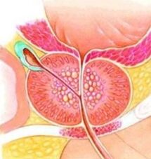 Adenom de prostată