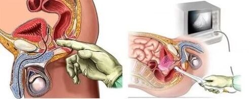 Diagnostic instrumental de prostatită